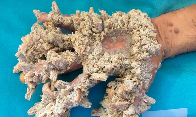 Un paciente con síndrome de ‘hombre de árbol’ ha sido operado con éxito